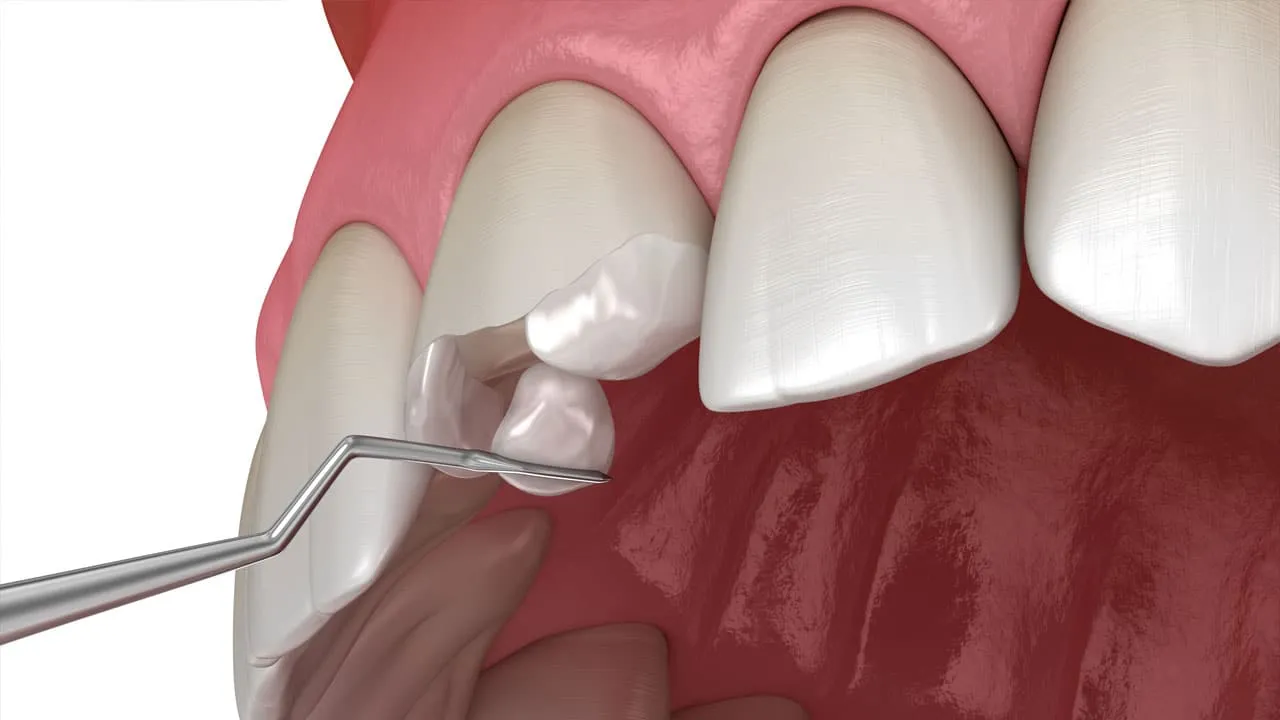 Save a Broken Tooth With Urgent Dental Care
